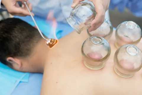 cupping therapy melbourne