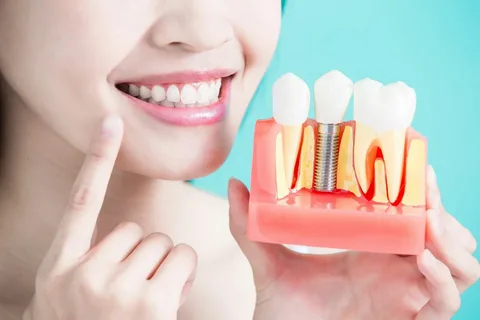 Dental Implant